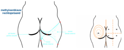 liposculptuur-liposuctie-zones-dr-dombard