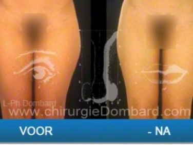 liposuctie kuiten enkels