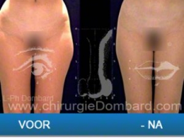 liposuctie kuiten enkels