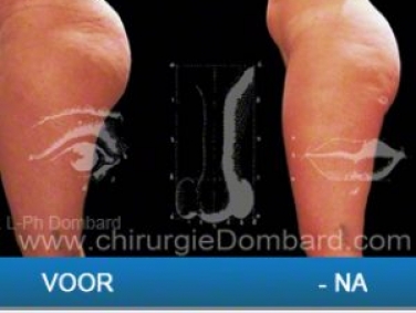 buik liposuctie belgie buik liposuctie belgie