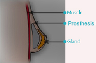 Chirurgie des seins - AUGMENTATION MAMMAIRE (IMPLANTS).