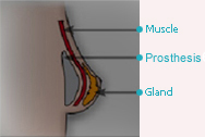 Chirurgie des seins - AUGMENTATION MAMMAIRE (IMPLANTS).