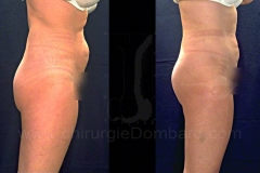 Lipofilling photo avant et après par le Docteur Dombard