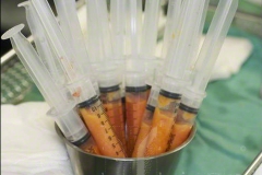 Graisses préparés avant injection dans les fesses pour une lipofilling
