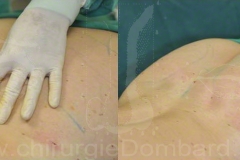 Lipofilling fesses et procedures