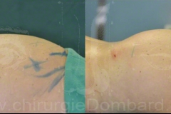 Lipofilling fesses et procedures