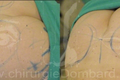 Lipofilling fesses et procedures