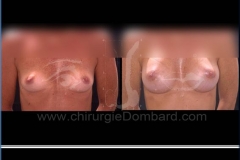 Borstvergroting (met implantaten)