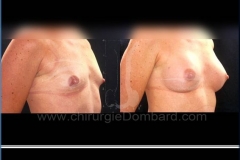 Borstvergroting (met implantaten)