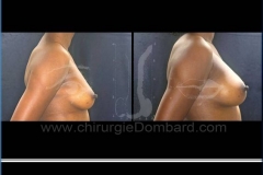 Borstvergroting (met implantaten)