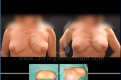 Borstvergroting (met implantaten)