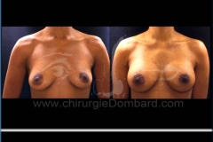 Borstvergroting (met implantaten)