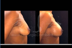 Borstvergroting (met implantaten)