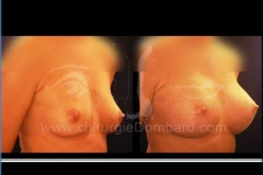 Borstvergroting (met implantaten)