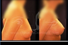 Borstvergroting (met implantaten)