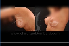 Borstvergroting (met implantaten)
