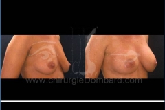 Borstvergroting (met implantaten)