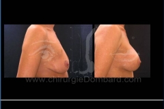 Borstvergroting (met implantaten)