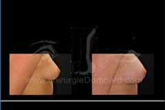 Borstvergroting (met implantaten)