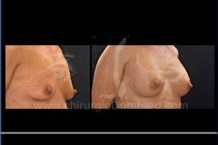 Borstvergroting (met implantaten)