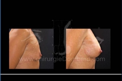 Borstvergroting (met implantaten)