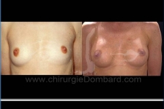 Borstvergroting (met implantaten)