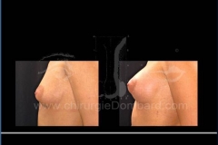 Borstvergroting (met implantaten)