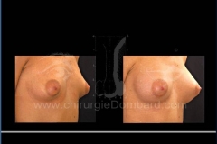 Borstvergroting (met implantaten)