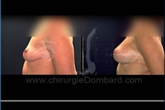 Borstvergroting (met implantaten)