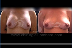 Borstvergroting (met implantaten)