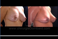 Borstvergroting (met implantaten)