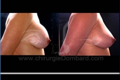 Borstvergroting (met implantaten)