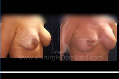 Borstvergroting (met implantaten)