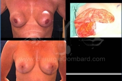 Borstvergroting (met implantaten)