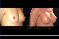 Borstvergroting (met implantaten)