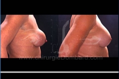 Borstvergroting (met implantaten)