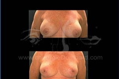 Borstvergroting (met implantaten)