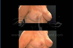 Borstvergroting (met implantaten)
