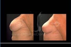 Borstvergroting (met implantaten)