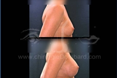Borstvergroting (met implantaten)
