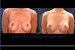 Borstvergroting (met implantaten)