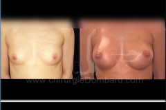 Borstvergroting (met implantaten)