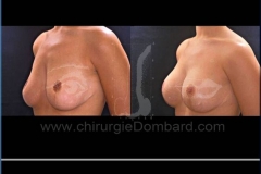 Borstvergroting (met implantaten)