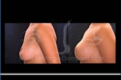 Borstvergroting (met implantaten)
