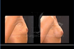 Borstvergroting (met implantaten)