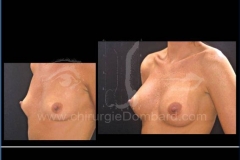Borstvergroting (met implantaten)
