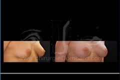 Borstvergroting (met implantaten)