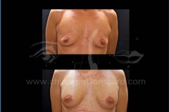 Borstvergroting (met implantaten)