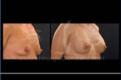 Borstvergroting (met implantaten)