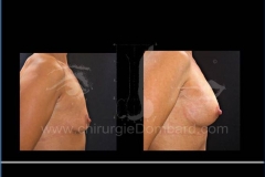 Borstvergroting (met implantaten)